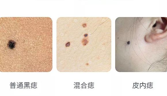 华亦俏朱红博士说：祛痣应该注意什么？
