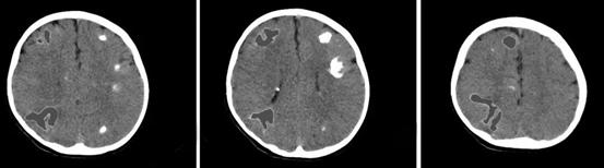 几百个“玉米粒”长满了7岁男孩的脑子，妈妈上演现实版药神