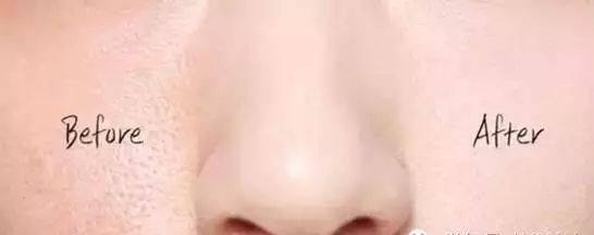 毛孔粗大皮肤暗黄干燥怎么办,毛孔粗大皮肤暗黄怎么治疗