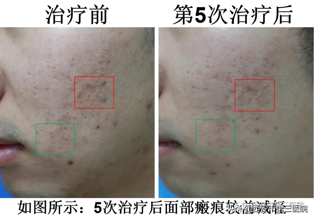 紧致肌肤的微针,淡化细纹微针