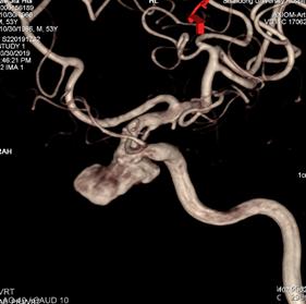 颈内动脉c3段动脉瘤是什么症状,右颈内动脉c3段动脉瘤是什么意思