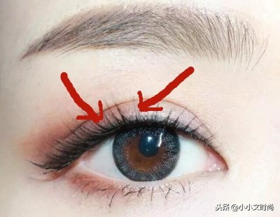 双眼皮后医生不建议用祛疤药,双眼皮手术后医生当场让看效果吗