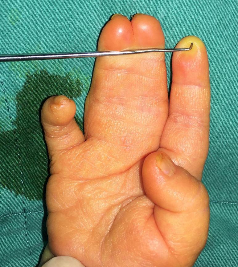 并指畸形免植皮案例,并指畸形