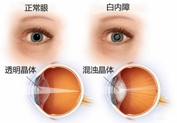 白内障到底是什么!你了解白内障吗?