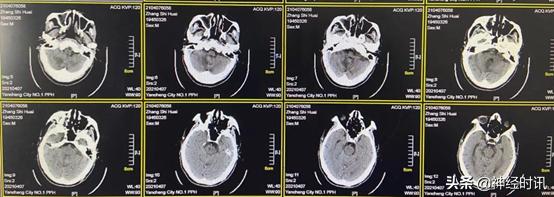 高血压小脑出血治愈率多大,高血压导致小脑出血