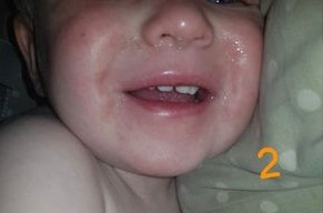 国外宝宝被邻居亲吻后中毒,婴儿被亲嘴感染什么症状