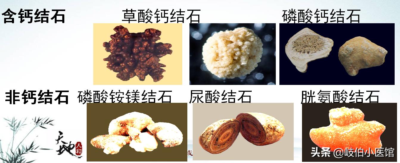 输尿管5mm结石体外冲击波碎石危害,体外冲击波碎石后尿出结石