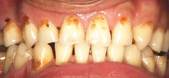 牙齿美白选什么洗牙方式,洗牙美白一般去哪里