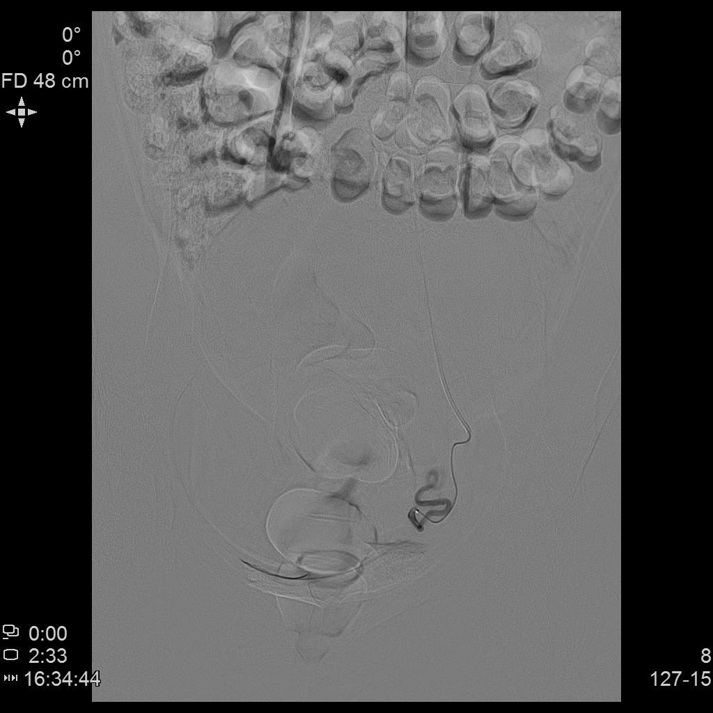 子宫肌瘤什么情况适合用介入栓塞,子宫肌瘤能做栓塞介入吗