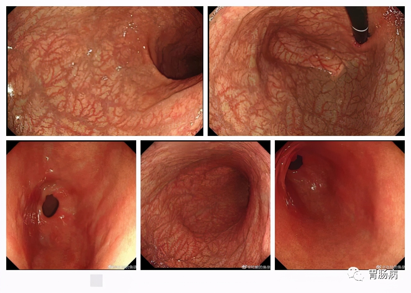 a型胃炎和b型胃炎鉴别,a型胃炎有胃窦萎缩吗