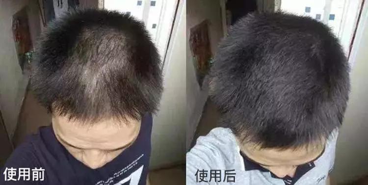 头油头皮屑多脱发洗发水,头油头皮屑多洗发水推荐