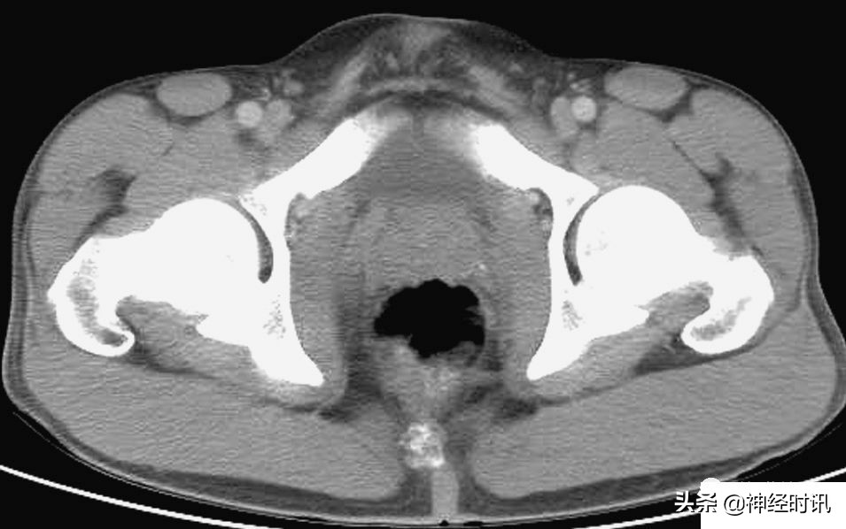 肾脏输尿管膀胱前列腺结构,肾输尿管膀胱解剖示意图