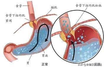 患者男性48岁吞咽困难1个月,吞咽困难阻碍睡眠