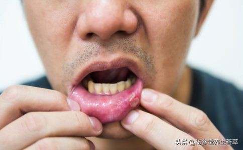 口腔溃疡有什么症状及治疗方法,口腔溃疡是怎么引起的最快解决法