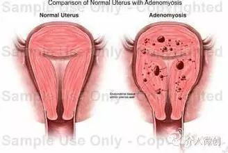 宫外孕保守治疗显示子宫腺肌症,子宫腺肌病保守治疗无效怎么办