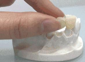 种植牙和烤瓷牙究竟有哪些区别？为什么都说种植牙好？