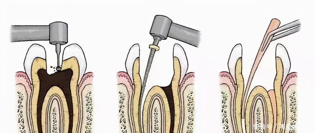 牙齿缺失做种植牙手术的详细过程,牙齿发炎治好了可以即刻种植牙吗