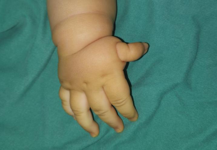 拇指多指手术后怎么护理,拇指漂浮指治疗康复案例