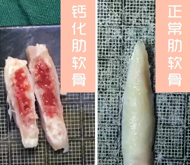 肋软骨隆鼻发生歪斜怎么办,造成隆鼻假体歪斜的原因