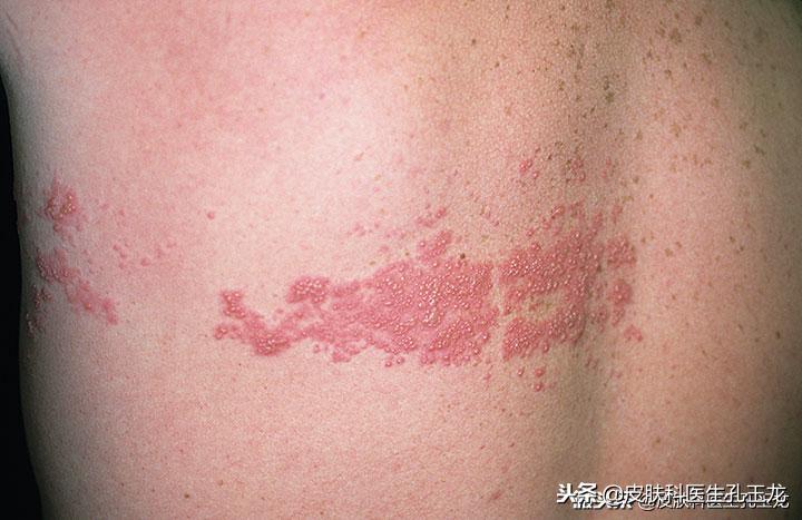 皮肤科疱疹神经痛,皮肤科看带状疱疹能治好神经痛吗