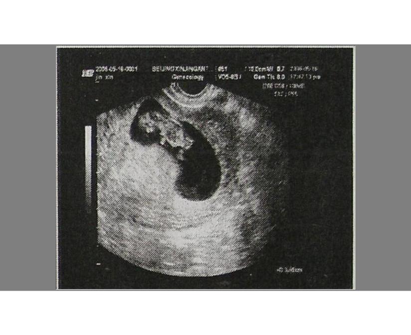 怀孕一般几周可以看到孕囊,孕囊大小判断大孕囊还是小孕囊