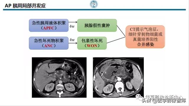 核磁ct都显示急性胰腺炎,急性坏死性胰腺炎的ct表现
