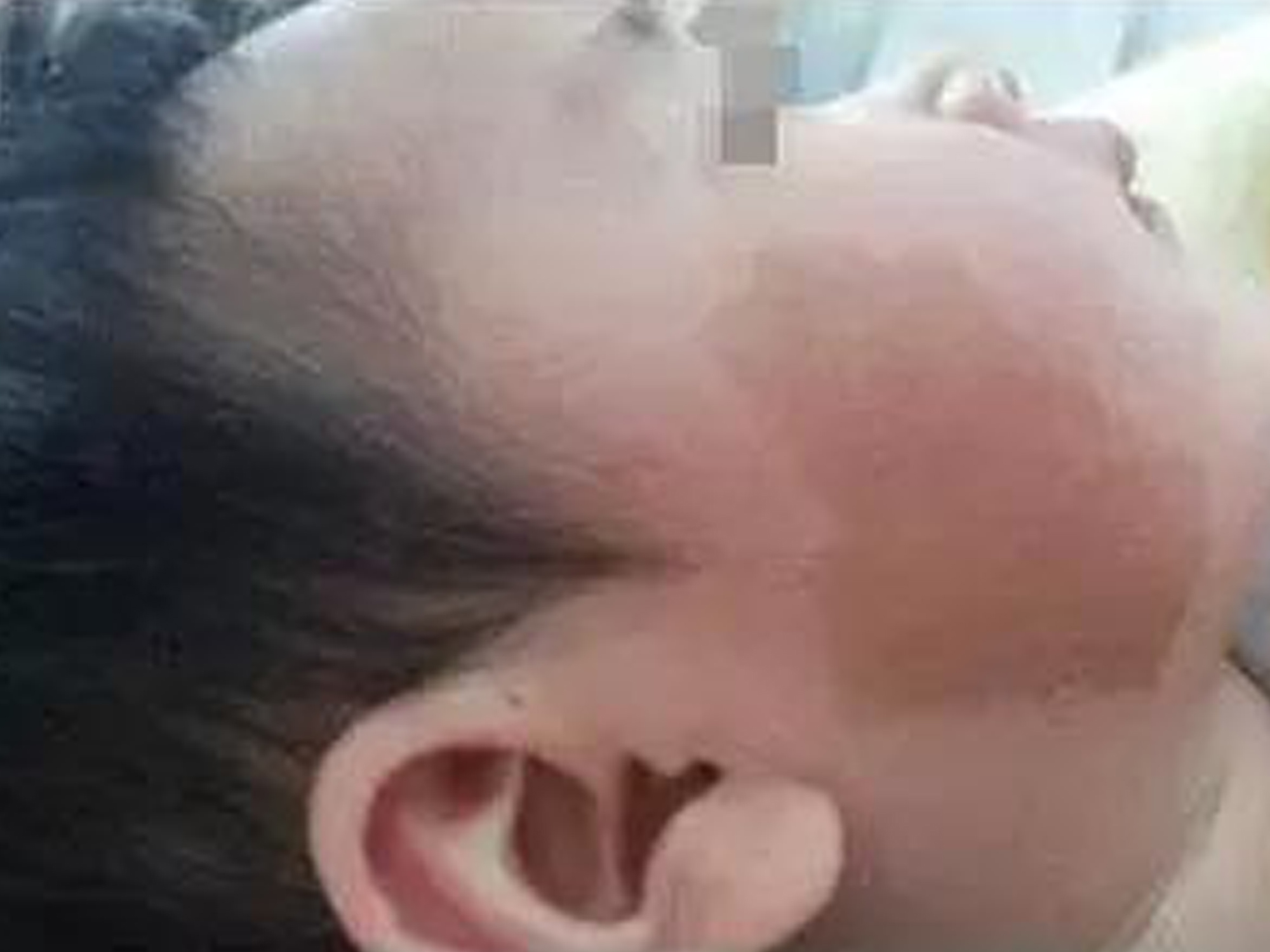 宝宝身上胎记是怎么形成的,宝宝身上的胎记一般长在哪里