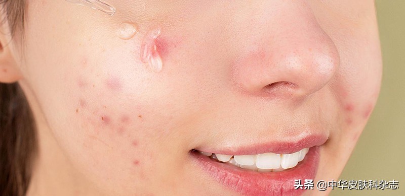 祛痘印痘疤最有用的药膏,激光祛痘印痘疤效果好吗