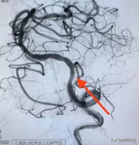 脑血管病介入治疗的介绍,缺血性脑血管病介入治疗进展2015