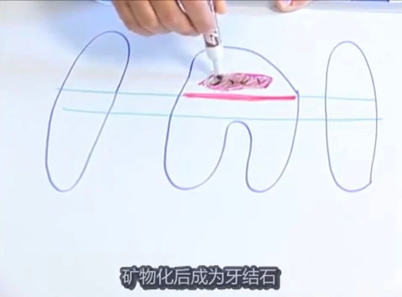 猫有牙结石牙龈红肿怎么治疗,猫已经有牙结石了怎么办