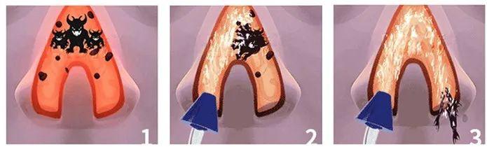 耳鼻喉鼻炎的自愈方法,冲洗鼻腔可以缓解过敏性鼻炎吗