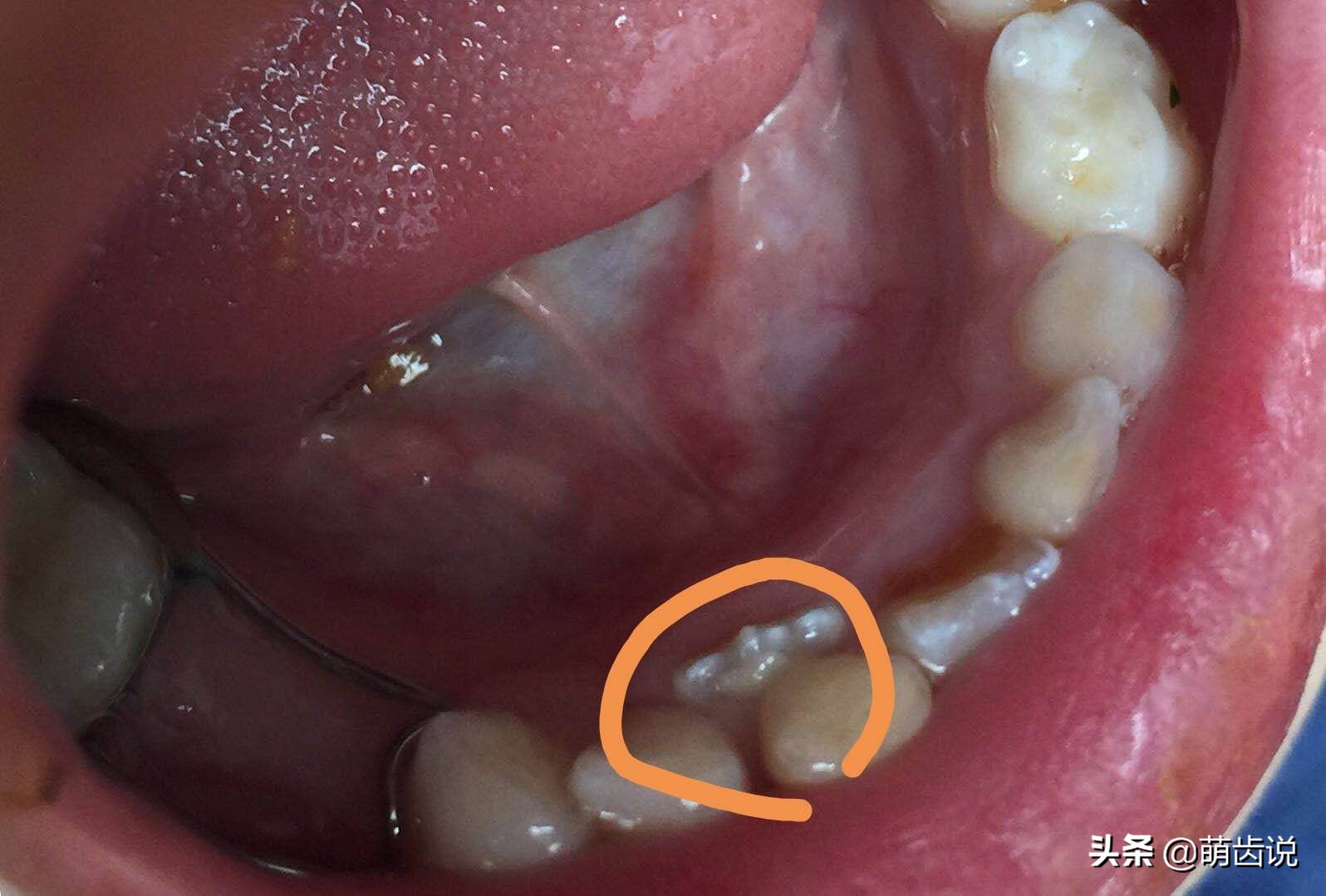 宝宝喊牙疼上嘴唇肿了是什么原因,宝宝牙疼为什么晚上疼得厉害