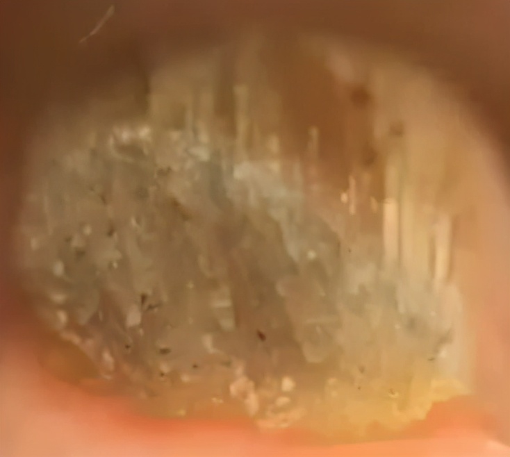 治灰指甲要验血吗,医院检查灰指甲挂号什么科