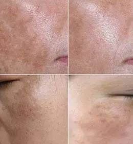 各种面部斑图片,如何辨别脸上的斑