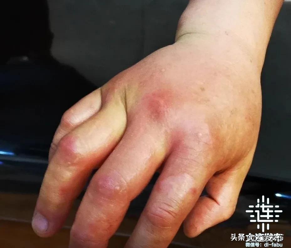 幼儿被马蜂蜇伤的新闻,孩子被蜜蜂蜇伤怎么正确处理