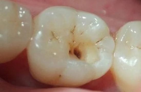 乳牙拔出恒牙不长在原来的位置,孩子的乳牙迟迟不掉怎么回事