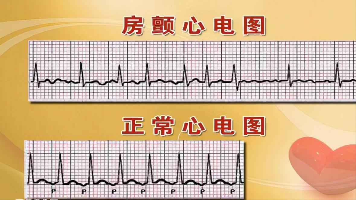 房颤引发中风的风险率是多少,房颤患者怎样预防栓塞
