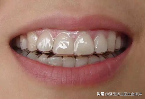 戴牙套能矫正兜齿吗,戴牙套会影响吐字不清吗