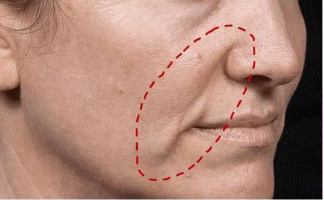 嘴角两旁的嘟嘟肉怎么去除,如何改善嘴角嘟嘟肉