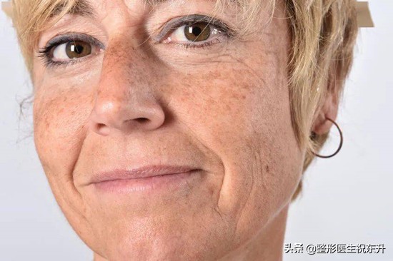 做了很多次医美法令纹还去不掉,法令纹的印子是不是去不掉了