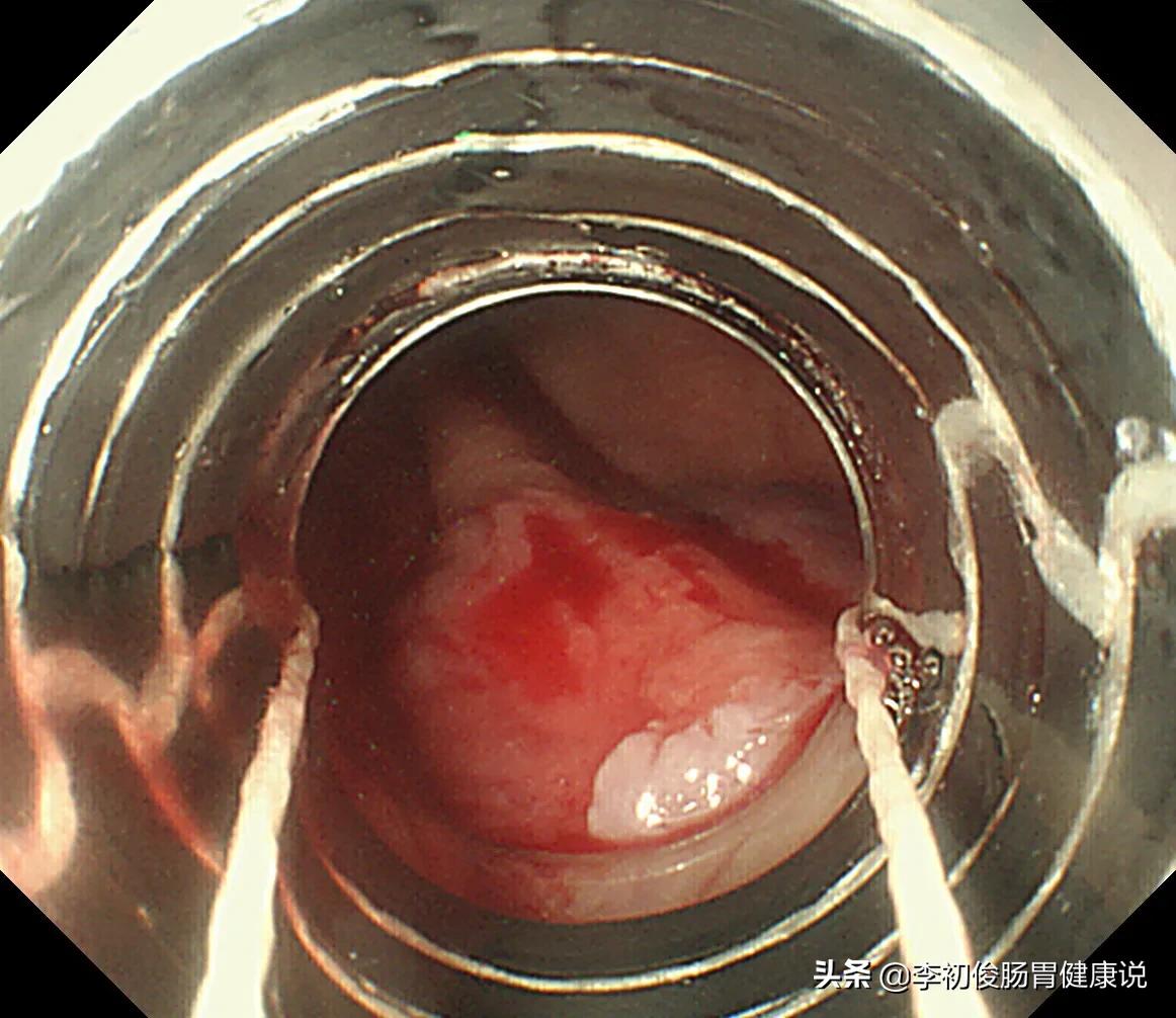 一次无痛胃肠镜一共需要多久,一次做完胃肠镜