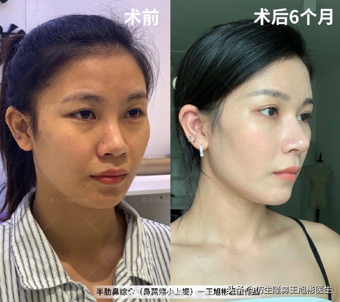 大鼻头缩小的改善原理,鼻头毛孔粗大如何改善缩小毛孔