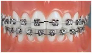 矫正牙齿很难受是怎么坚持下来的,矫正牙齿的过来人的忠告