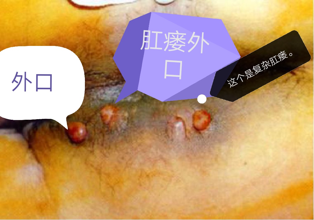 肛瘘内口愈合了还要不要做手术,肛瘘手术当天要不要人照顾