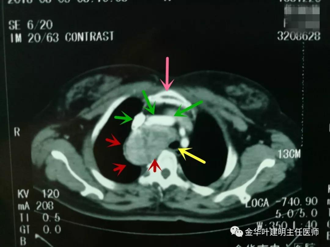 甲状腺肿瘤超大,胸骨后甲状腺肿病情是否很严重