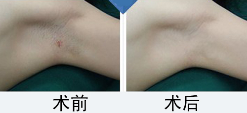 手术治疗狐臭需要住院吗,治疗狐臭手术应挂什么科