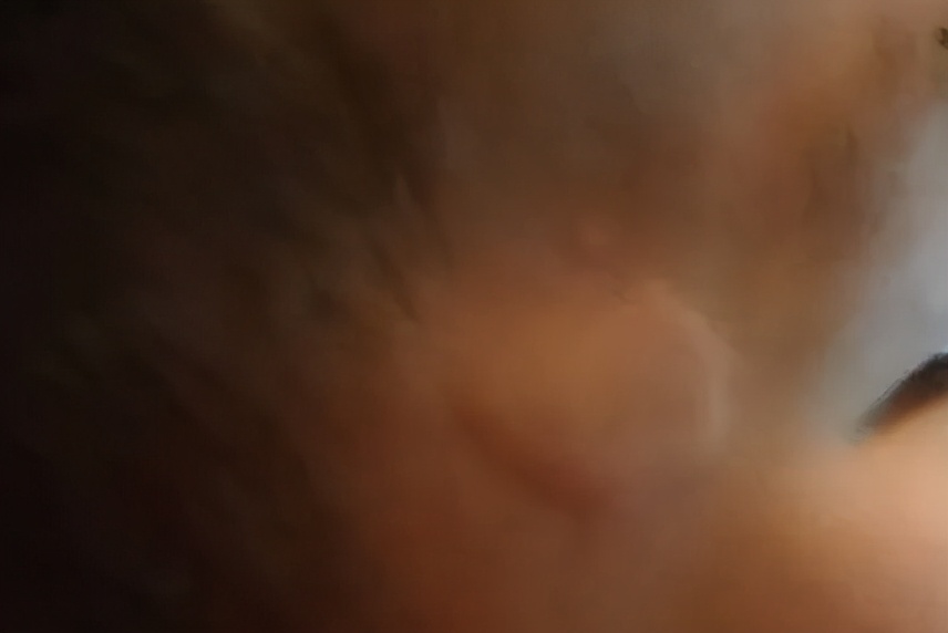 儿童得了过敏性荨麻疹很痒怎么办,儿童荨麻疹反复发作三招教你搞定