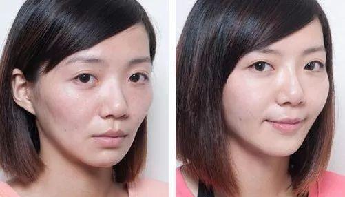 超声刀和热玛吉哪个提升效果好,超声刀和埋线提升哪个效果好