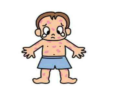 孩子吃海鲜过敏后续,孩子吃海鲜过敏起红疹发烧吗