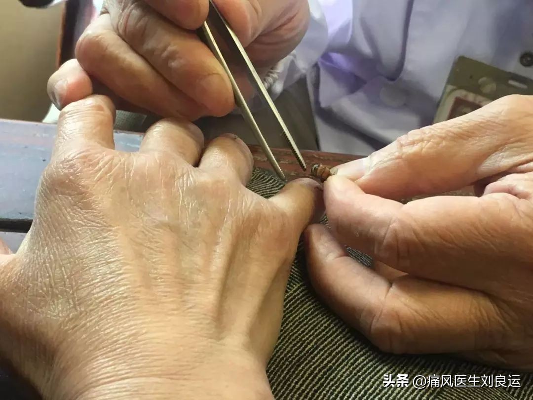 蜂针疗法可以治疗痛风吗,蜂疗灸可以治疗痛风吗